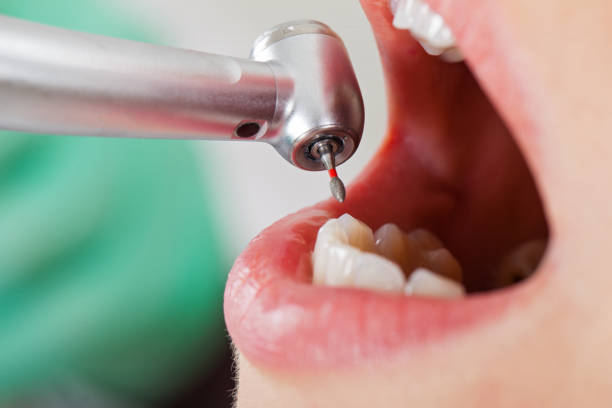 Best Emergency Dental Extractions in Winsted, CT